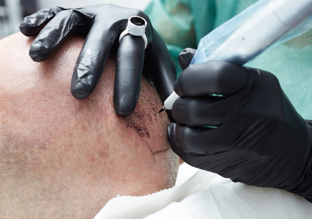 tout-ce-quil-faut-savoir-sur-la-tricopigmentation-a-lyon-1 Tout ce qu’il faut savoir sur la tricopigmentation à Lyon