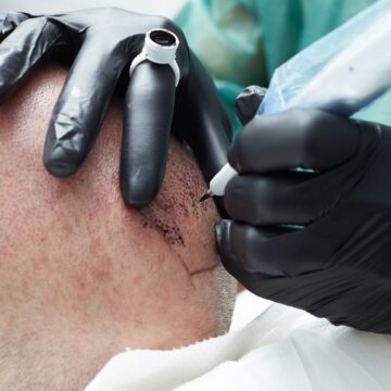 Tout ce qu’il faut savoir sur la tricopigmentation à Lyon